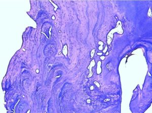 White-tailed deer tooth section showing extreme abnormal histology